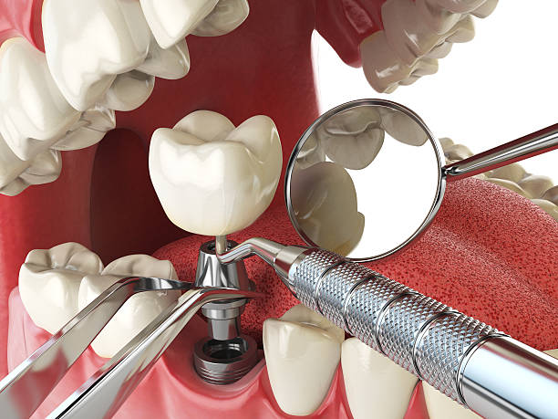 Best Emergency Root Canal Treatment in Sharon, PA